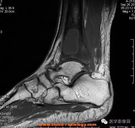 【病例】胫骨骨脓肿1例MR影像表现 【病例】胫骨骨脓肿1例MR影像表现