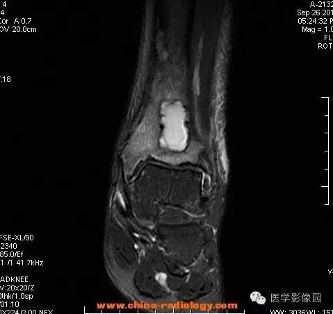 【病例】胫骨骨脓肿1例MR影像表现 【病例】胫骨骨脓肿1例MR影像表现