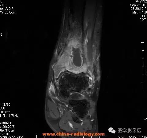 【病例】胫骨骨脓肿1例MR影像表现 【病例】胫骨骨脓肿1例MR影像表现