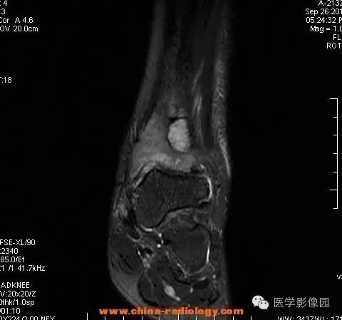 【病例】胫骨骨脓肿1例MR影像表现 【病例】胫骨骨脓肿1例MR影像表现