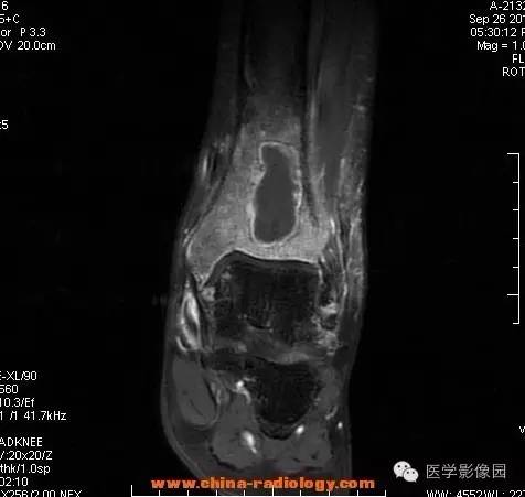 【病例】胫骨骨脓肿1例MR影像表现 【病例】胫骨骨脓肿1例MR影像表现
