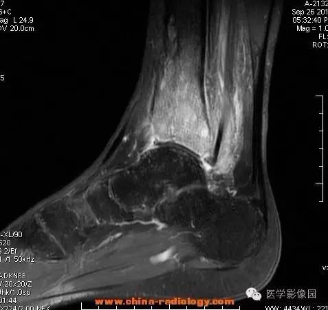 【病例】胫骨骨脓肿1例MR影像表现 【病例】胫骨骨脓肿1例MR影像表现
