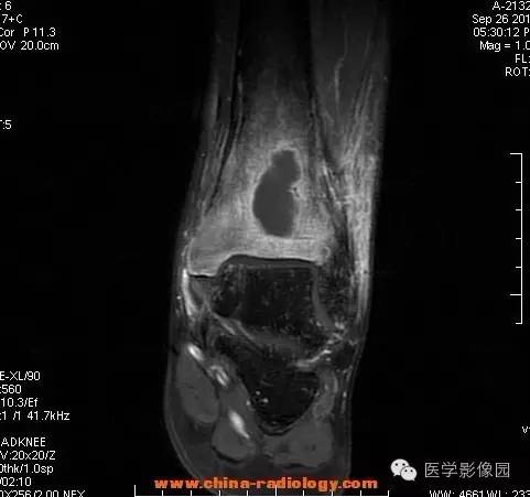 【病例】胫骨骨脓肿1例MR影像表现 【病例】胫骨骨脓肿1例MR影像表现
