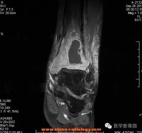 【病例】胫骨骨脓肿1例MR影像表现 【病例】胫骨骨脓肿1例MR影像表现