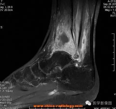 【病例】胫骨骨脓肿1例MR影像表现 【病例】胫骨骨脓肿1例MR影像表现