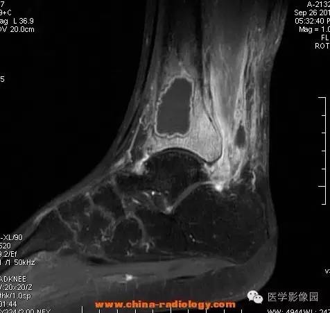 【病例】胫骨骨脓肿1例MR影像表现 【病例】胫骨骨脓肿1例MR影像表现
