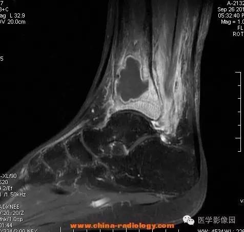 【病例】胫骨骨脓肿1例MR影像表现 【病例】胫骨骨脓肿1例MR影像表现