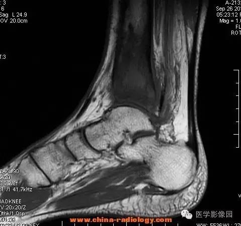 【病例】胫骨骨脓肿1例MR影像表现 【病例】胫骨骨脓肿1例MR影像表现