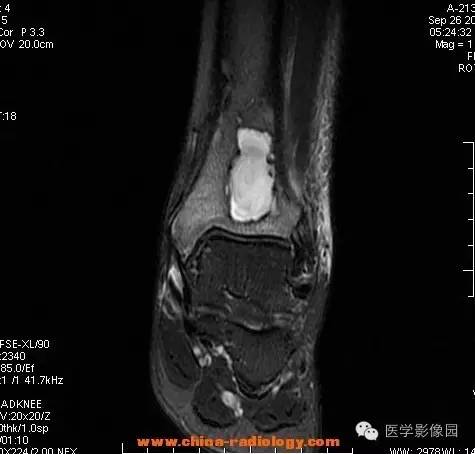 【病例】胫骨骨脓肿1例MR影像表现 【病例】胫骨骨脓肿1例MR影像表现