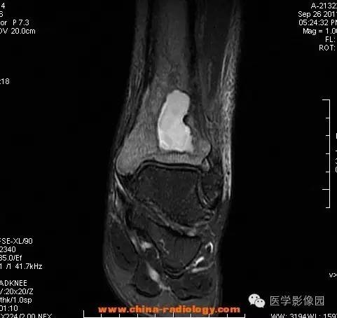 【病例】胫骨骨脓肿1例MR影像表现 【病例】胫骨骨脓肿1例MR影像表现