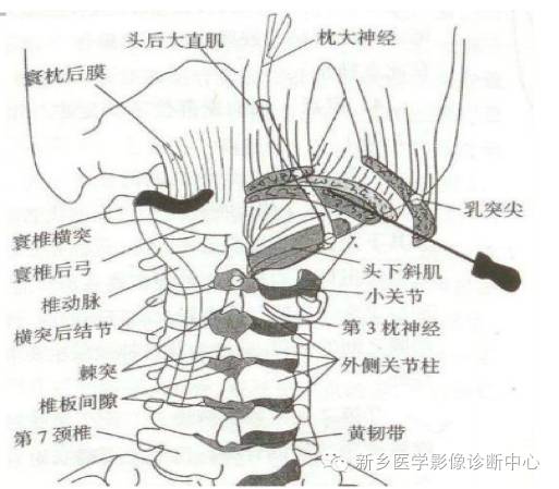 枕大神经卡压综合征 枕大神经卡压综合征