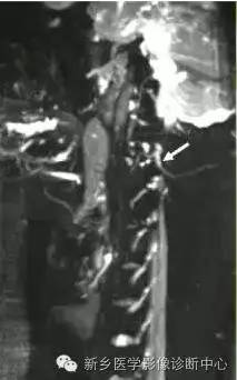 枕大神经卡压综合征