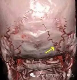 枕大神经卡压综合征 枕大神经卡压综合征