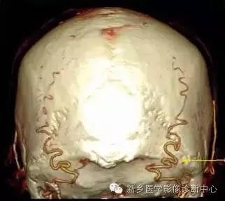 枕大神经卡压综合征 枕大神经卡压综合征