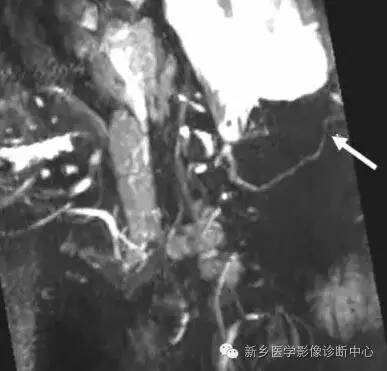 枕大神经卡压综合征 枕大神经卡压综合征