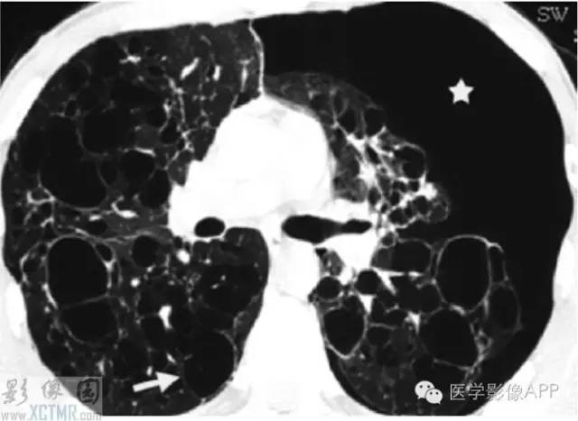 胸部组织细胞病影像学表现 胸部组织细胞病影像学表现