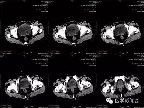 【病例】脐尿管囊肿合并感染1例CT影像表现 【病例】脐尿管囊肿合并感染1例CT影像表现