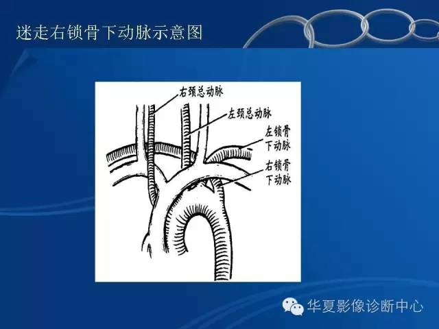 【PPT】少见变异：迷走右锁骨下动脉