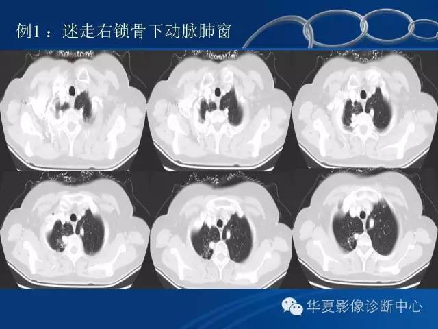 【PPT】少见变异：迷走右锁骨下动脉