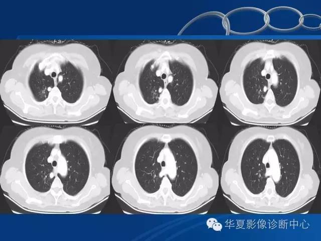 【PPT】少见变异：迷走右锁骨下动脉