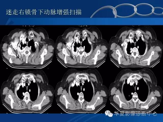 【PPT】少见变异：迷走右锁骨下动脉