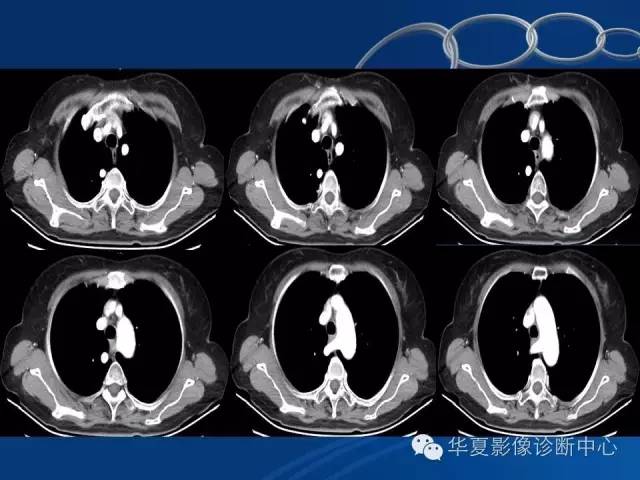 【PPT】少见变异：迷走右锁骨下动脉