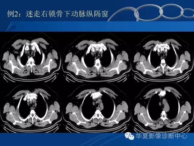 【PPT】少见变异：迷走右锁骨下动脉