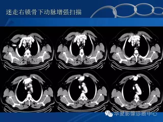 【PPT】少见变异：迷走右锁骨下动脉