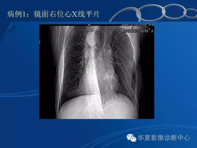 【PPT】先天性心脏、大血管位置异常