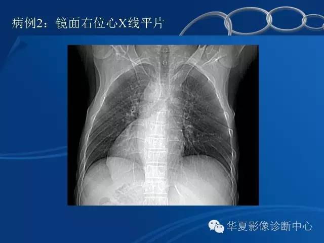【PPT】先天性心脏、大血管位置异常