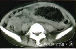 【病例】纱布瘤1例CT影像表现 【病例】纱布瘤1例CT影像表现