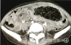 【病例】纱布瘤1例CT影像表现 【病例】纱布瘤1例CT影像表现