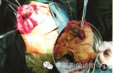 【病例】纱布瘤1例CT影像表现 【病例】纱布瘤1例CT影像表现
