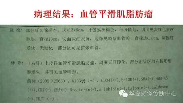 【病例】肝脏血管平滑肌脂肪瘤1例CT影像表现