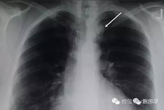 X线诊断的细微关键点 X线诊断的细微关键点