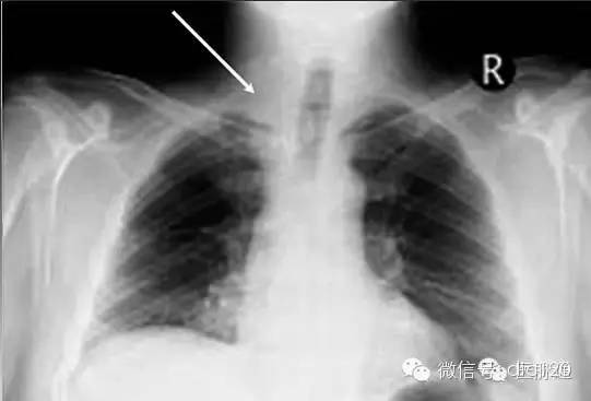 X线诊断的细微关键点 X线诊断的细微关键点