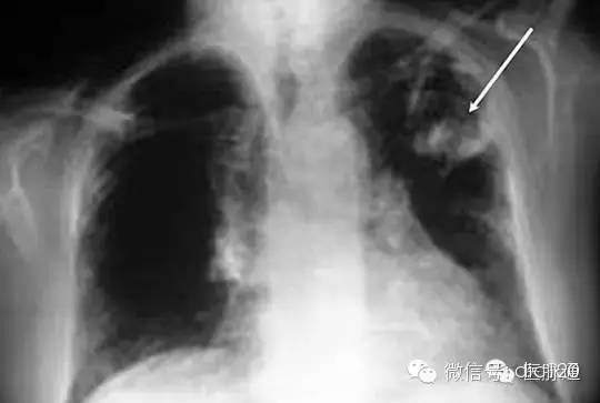 X线诊断的细微关键点 X线诊断的细微关键点