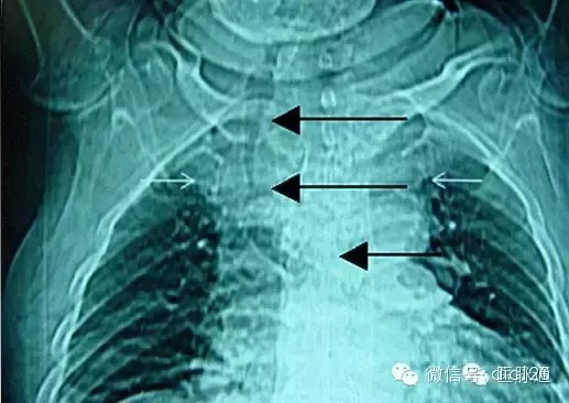 X线诊断的细微关键点 X线诊断的细微关键点