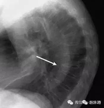 X线诊断的细微关键点 X线诊断的细微关键点