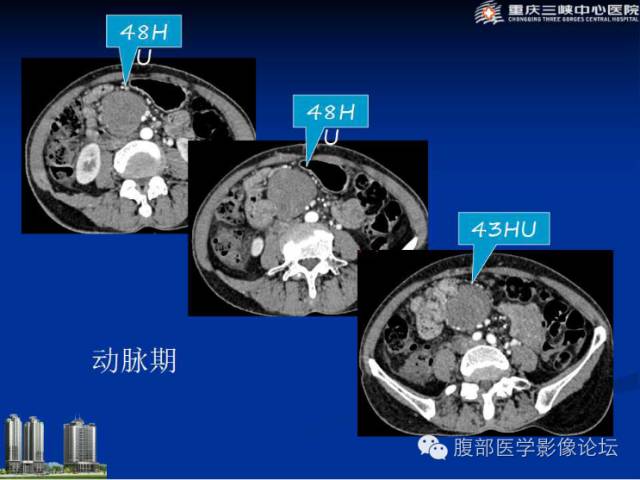 【病例】肠系膜韧带样纤维瘤1例CT影像表现 【病例】肠系膜韧带样纤维瘤1例CT影像表现