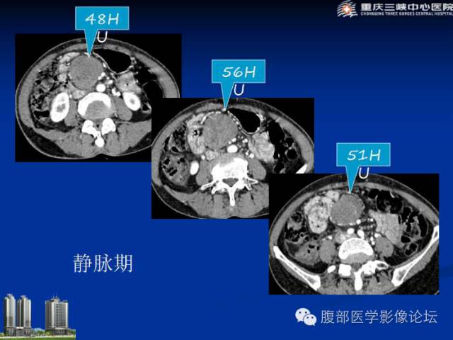 【病例】肠系膜韧带样纤维瘤1例CT影像表现 【病例】肠系膜韧带样纤维瘤1例CT影像表现