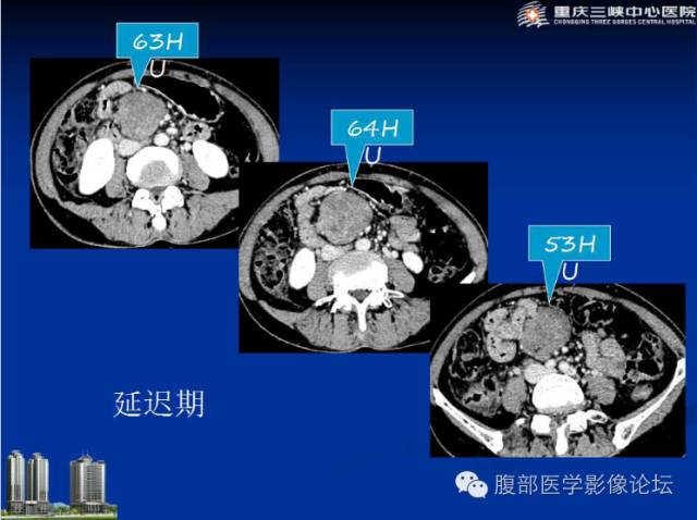 【病例】肠系膜韧带样纤维瘤1例CT影像表现 【病例】肠系膜韧带样纤维瘤1例CT影像表现