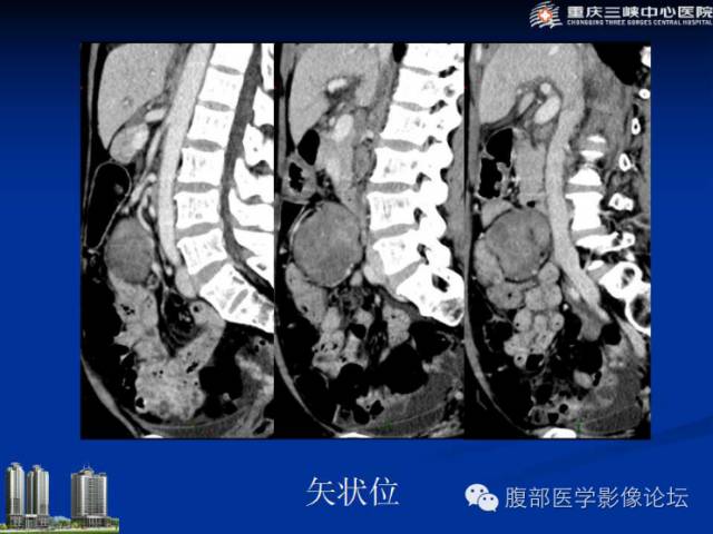 【病例】肠系膜韧带样纤维瘤1例CT影像表现 【病例】肠系膜韧带样纤维瘤1例CT影像表现