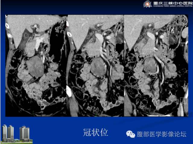 【病例】肠系膜韧带样纤维瘤1例CT影像表现 【病例】肠系膜韧带样纤维瘤1例CT影像表现