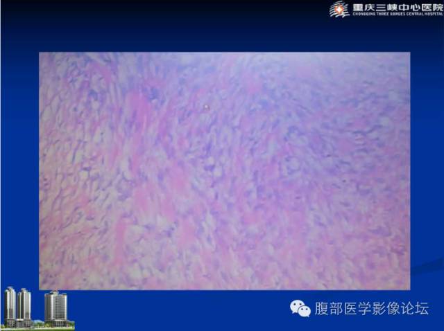 【病例】肠系膜韧带样纤维瘤1例CT影像表现 【病例】肠系膜韧带样纤维瘤1例CT影像表现