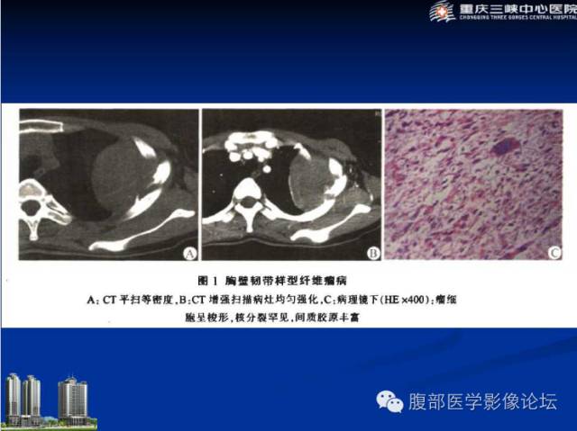 【病例】肠系膜韧带样纤维瘤1例CT影像表现 【病例】肠系膜韧带样纤维瘤1例CT影像表现