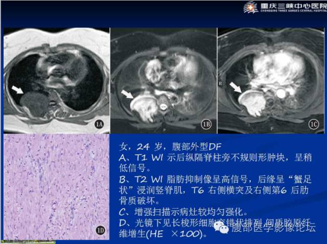 【病例】肠系膜韧带样纤维瘤1例CT影像表现 【病例】肠系膜韧带样纤维瘤1例CT影像表现