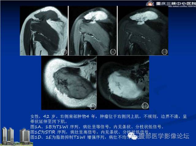 【病例】肠系膜韧带样纤维瘤1例CT影像表现 【病例】肠系膜韧带样纤维瘤1例CT影像表现