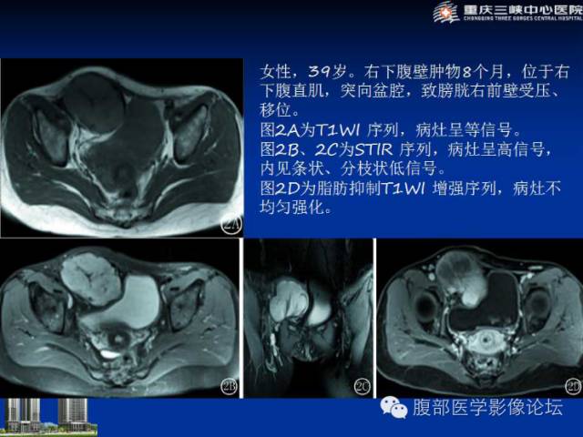 【病例】肠系膜韧带样纤维瘤1例CT影像表现 【病例】肠系膜韧带样纤维瘤1例CT影像表现