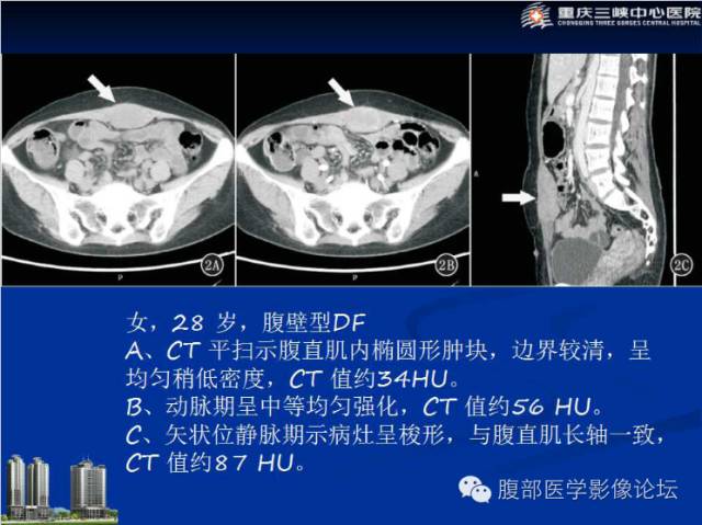 【病例】肠系膜韧带样纤维瘤1例CT影像表现 【病例】肠系膜韧带样纤维瘤1例CT影像表现